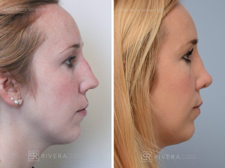 Aesthetic rhinoplasty nose surgery (oblique/front first) in female patient - Nose Surgery (Rhinoplasty) - Before and after case 6 - Profile view