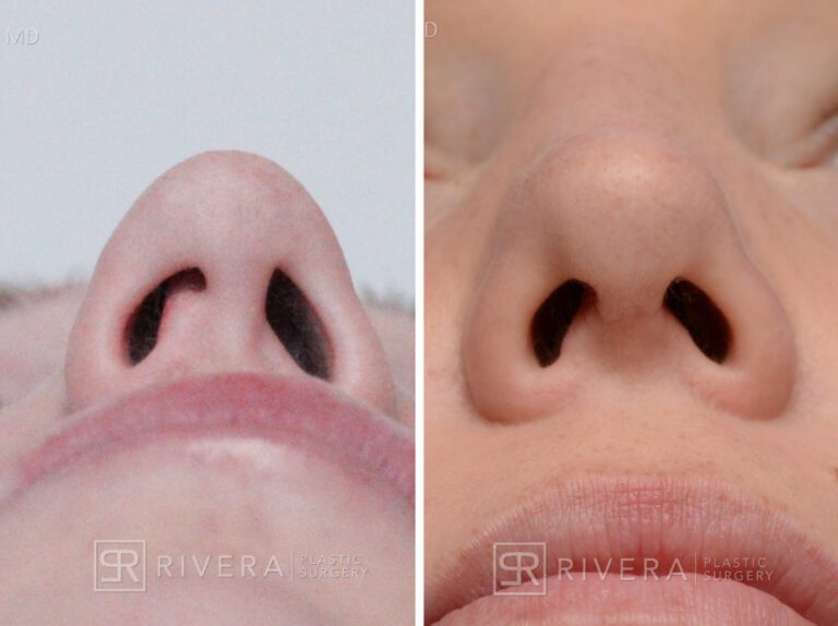 Aesthetic rhinoplasty nose surgery (oblique/front first) in female patient - Nose Surgery (Rhinoplasty) - Before and after case 6 - Zoomed inferior view