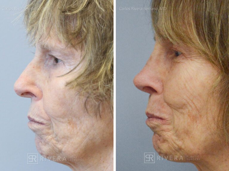 Aesthetic rhinoplasty nose surgery (oblique/front first) in female patient - Nose Surgery (Rhinoplasty) - Before and after case 7 - Profile view