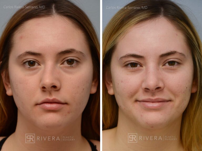 Aesthetic rhinoplasty nose surgery (oblique/front first) in female patient - Nose Surgery (Rhinoplasty) - Before and after case 8 - Frontal view