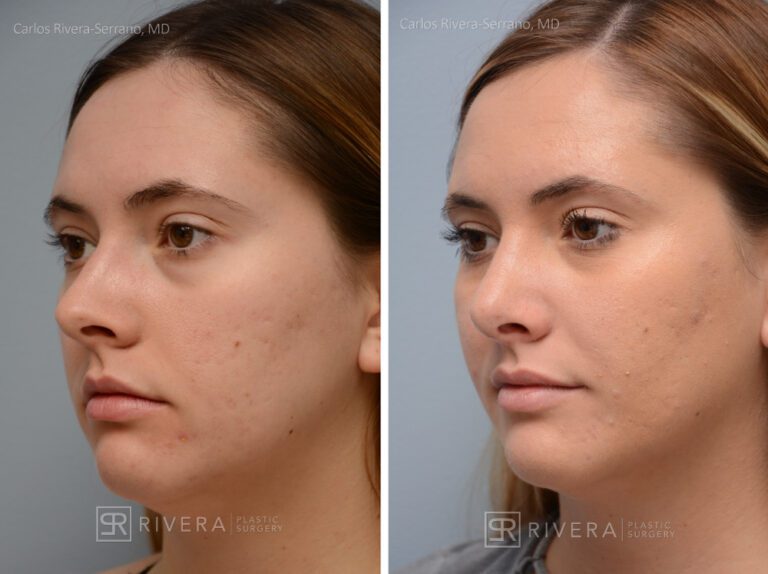 Aesthetic rhinoplasty nose surgery (oblique/front first) in female patient - Nose Surgery (Rhinoplasty) - Before and after case 8 - Lateral view