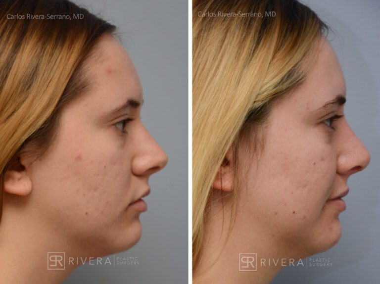 Aesthetic rhinoplasty nose surgery (oblique/front first) in female patient - Nose Surgery (Rhinoplasty) - Before and after case 8 - Profile view