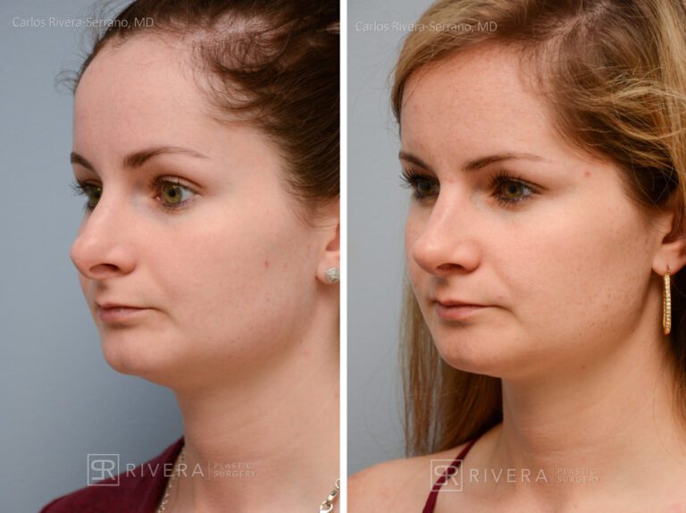 Aesthetic rhinoplasty nose surgery (oblique/front first) in female patient - Nose Surgery (Rhinoplasty) - Before and after case 9 - Lateral view