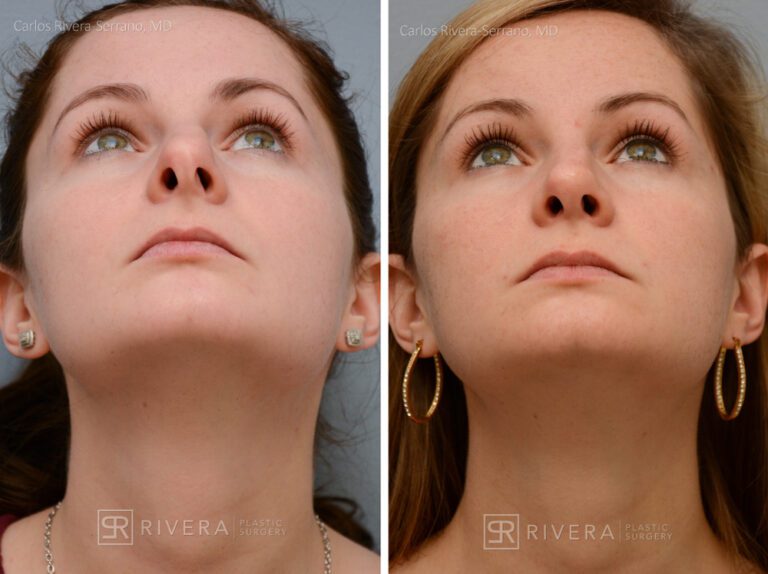 Aesthetic rhinoplasty nose surgery (oblique/front first) in female patient - Nose Surgery (Rhinoplasty) - Before and after case 9 - Inferior view