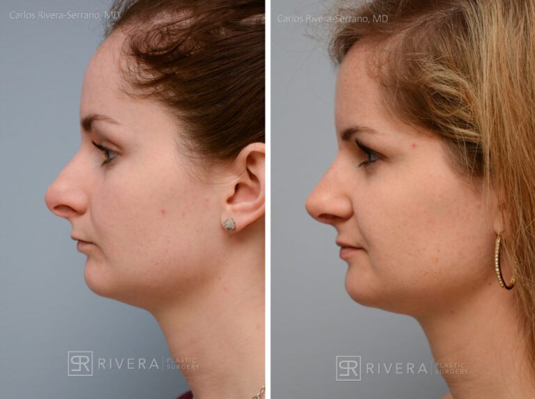 Aesthetic rhinoplasty nose surgery (oblique/front first) in female patient - Nose Surgery (Rhinoplasty) - Before and after case 9 - Profile view