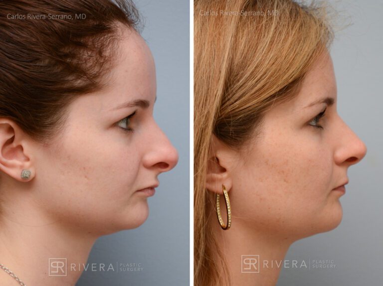 Aesthetic rhinoplasty nose surgery (oblique/front first) in female patient - Nose Surgery (Rhinoplasty) - Before and after case 9 - Profile view