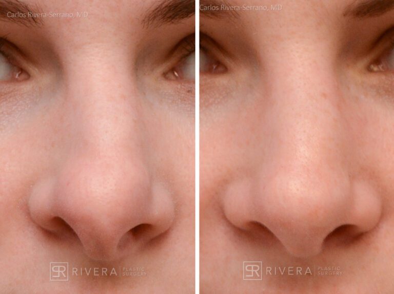Aesthetic rhinoplasty nose surgery (oblique/front first) in female patient - Nose Surgery (Rhinoplasty) - Before and after case 9 - Zoomed frontal view