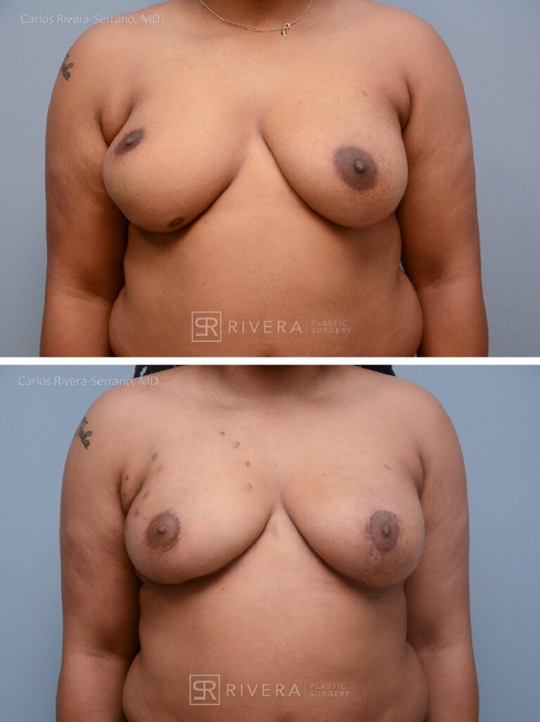 Congenital breast asymmetry treated with right breast fat grafting - fat transfer reshaping, and left breast lift to improve symmetry. - Woman - Case 2201 - Before and after - Frontal view