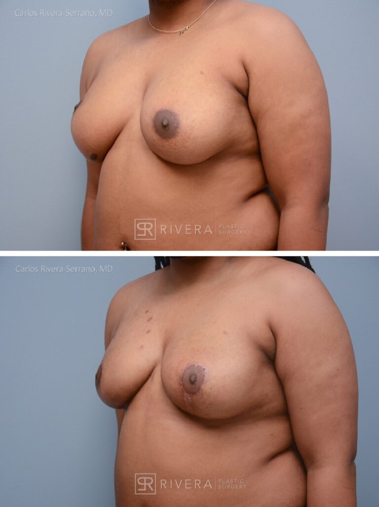 Congenital breast asymmetry treated with right breast fat grafting - fat transfer reshaping, and left breast lift to improve symmetry. - Woman - Case 2201 - Before and after - Oblique view