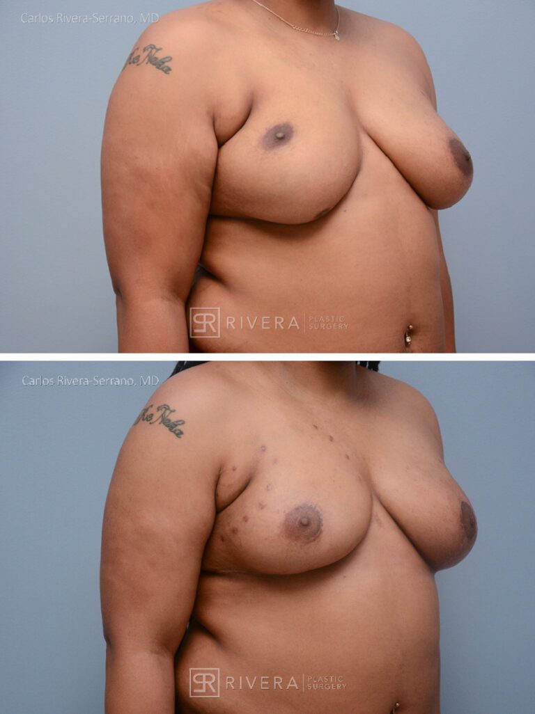 Congenital breast asymmetry treated with right breast fat grafting - fat transfer reshaping, and left breast lift to improve symmetry. - Woman - Case 2201 - Before and after - Oblique view