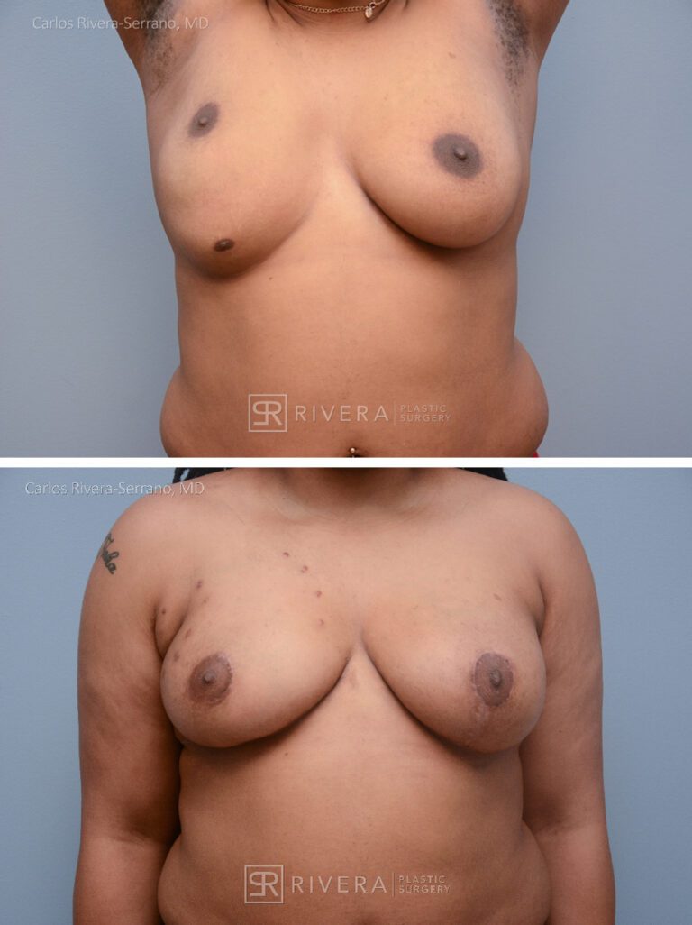 Congenital breast asymmetry treated with right breast fat grafting - fat transfer reshaping, and left breast lift to improve symmetry. - Woman - Case 2201 - Before and after - Frontal view