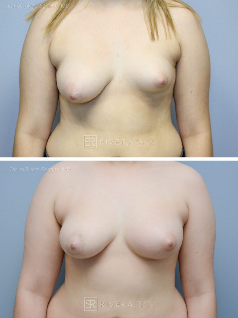 breastaugmentationwithfattransfer case2 dr carlos rivera serrano