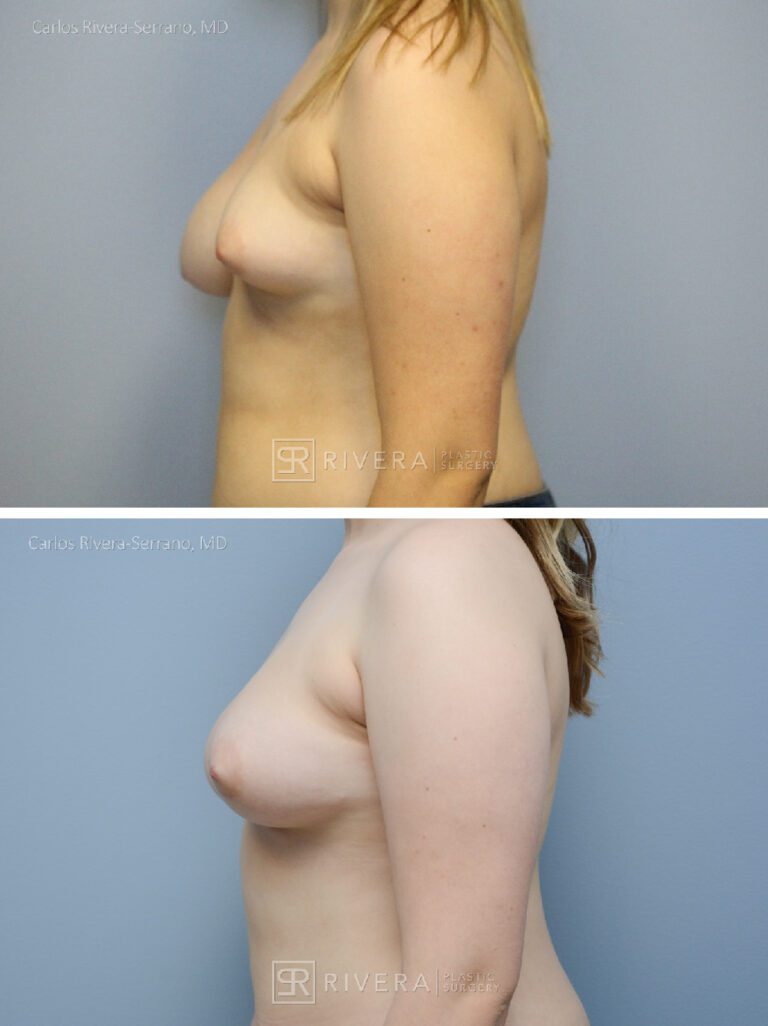 Congenital breast asymmetry treated with 3 rounds of left breast fat grafting- fat transfer and a right breast lift to improve symmetry - Woman - Case 2202 - Before and after - Lateral view