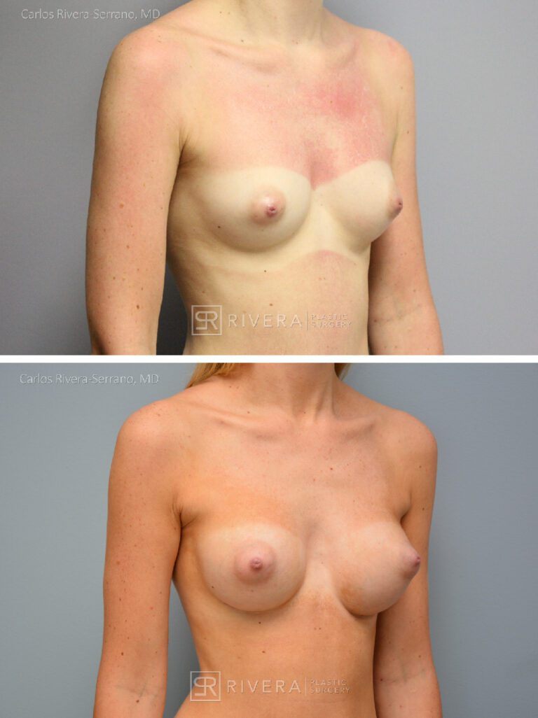 Dual plane breast augmentation saline filled non textured implants, Inframmary approach - Woman - Case 21103 - Before and after - Oblique view