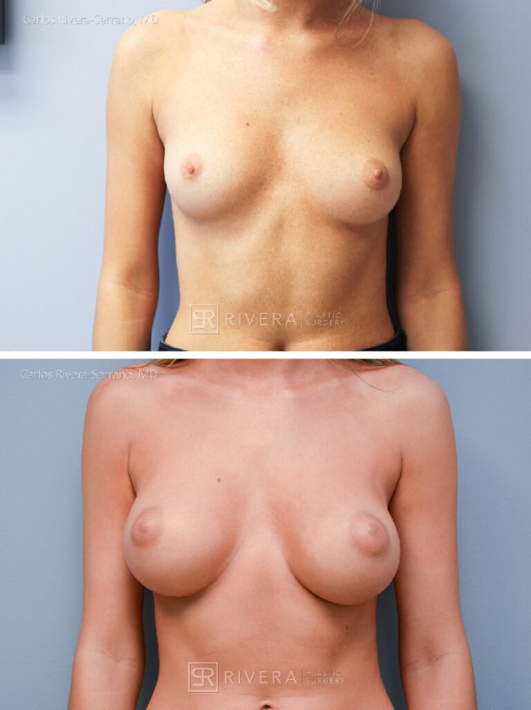 Dual plane breast augmentation saline filled non textured implants, Inframmary approach - Woman - Case 21104 - Before and after - Frontal view