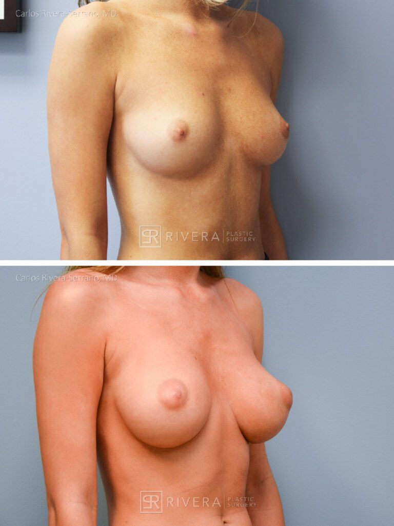 Dual plane breast augmentation saline filled non textured implants, Inframmary approach - Woman - Case 21104 - Before and after - Oblique view