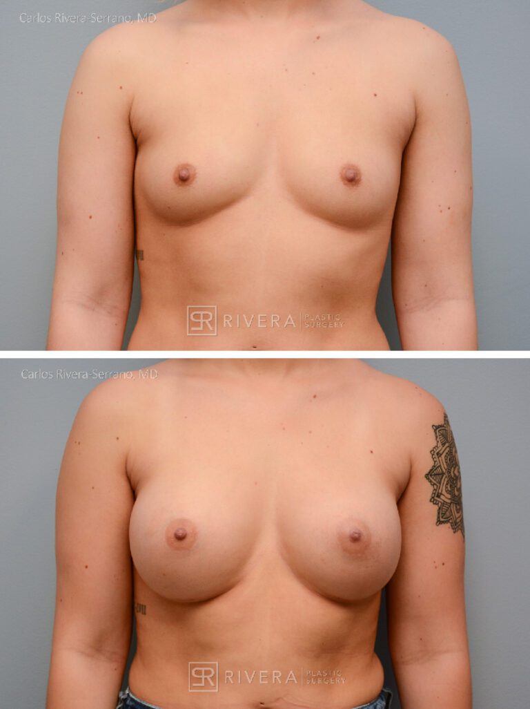 Dual plane breast augmentation 345 cc silicone non textured implants, Inframmary approach - Woman - Case 21106 - Before and after - Frontal view