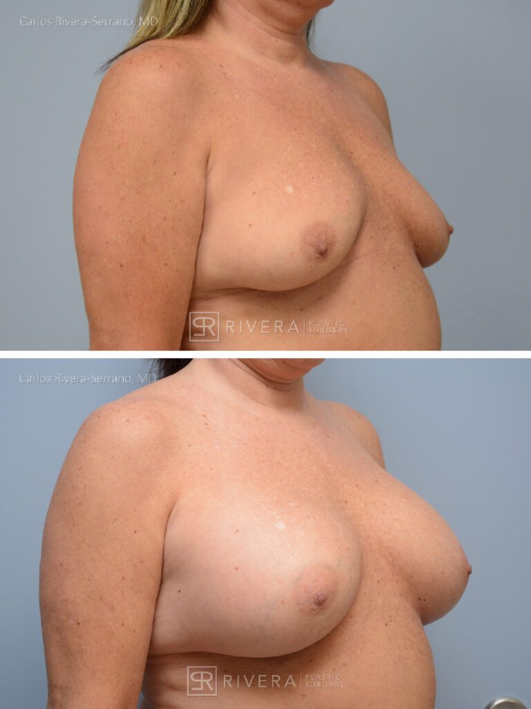 Dual plane breast augmentation 545 cc silicone non textured implants, Inframmary approach - Woman - Case 21107 - Before and after - Oblique view