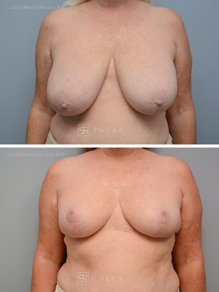 breastreduction case1 dr carlos rivera serrano