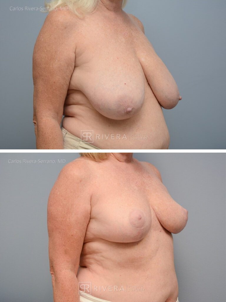 breastreduction case1.1 dr carlos rivera serrano