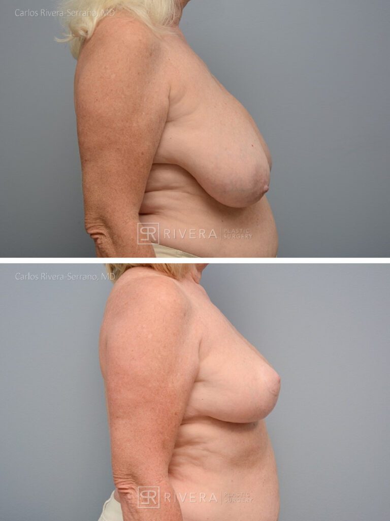 Bilateral breast reduction superomedial dermoglandular pedicle, Wise skin pattern approach (inverted T) - Woman - Case 2301 - Before and after - Lateral view