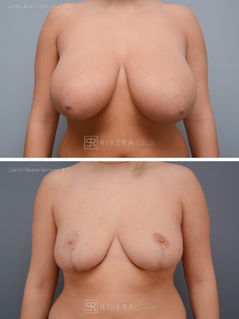 breastreduction case11 dr carlos rivera serrano