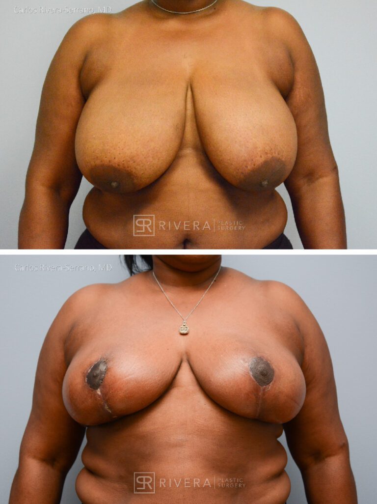 Bilateral breast reduction superomedial dermoglandular pedicle, Wise skin pattern approach (inverted T) - Woman - Case 23013 - Before and after - Frontal view