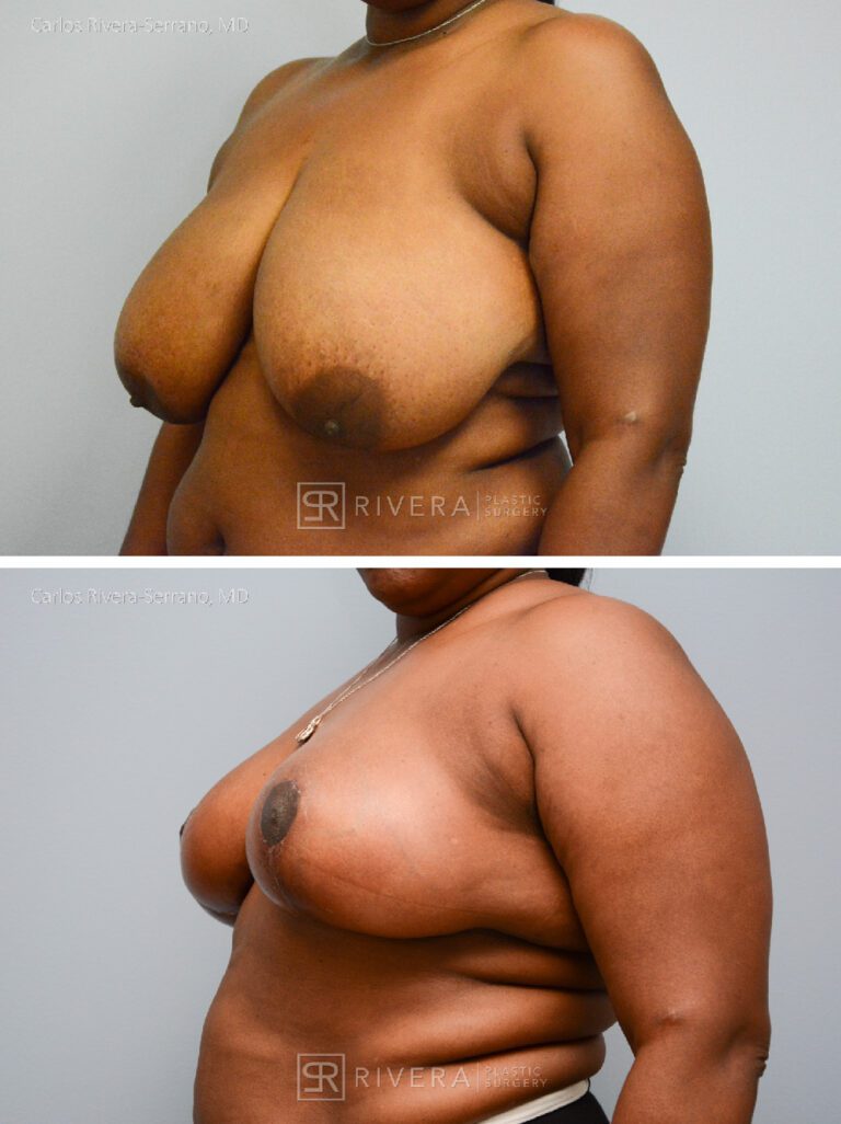 Bilateral breast reduction superomedial dermoglandular pedicle, Wise skin pattern approach (inverted T) - Woman - Case 23013 - Before and after - Oblique view