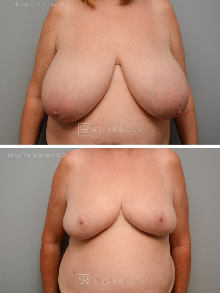 Bilateral breast reduction inferior dermoglandular pedicle, horizontal skin approach (no vertical scar) - Woman - Case 23014 - Before and after - Frontal view