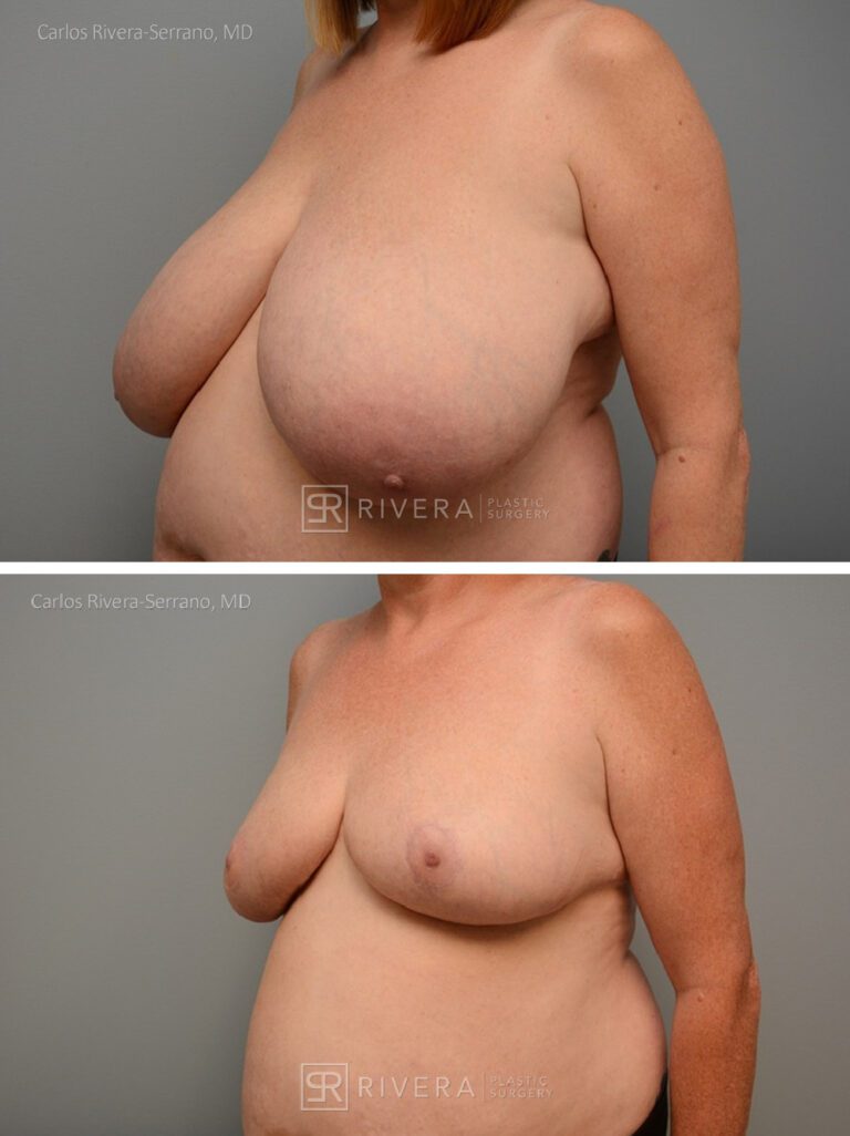 Bilateral breast reduction inferior dermoglandular pedicle, horizontal skin approach (no vertical scar) - Woman - Case 23014 - Before and after - Oblique view