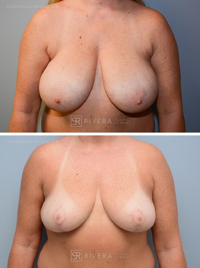 Bilateral breast reduction superomedial dermoglandular pedicle, Wise skin pattern approach (inverted T) - Woman - Case 2302 - Before and after - Frontal view