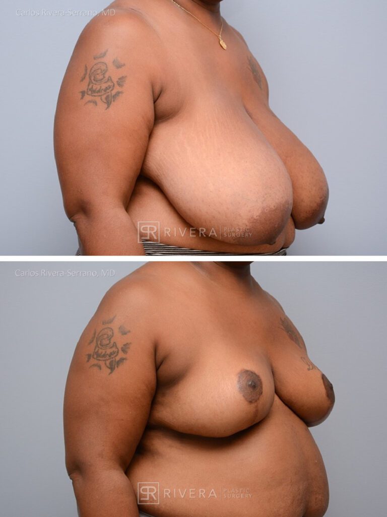 Bilateral breast reduction inferior dermoglandular pedicle, Wise skin pattern approach (inverted T) - Woman - Case 2304 - Before and after - Oblique view