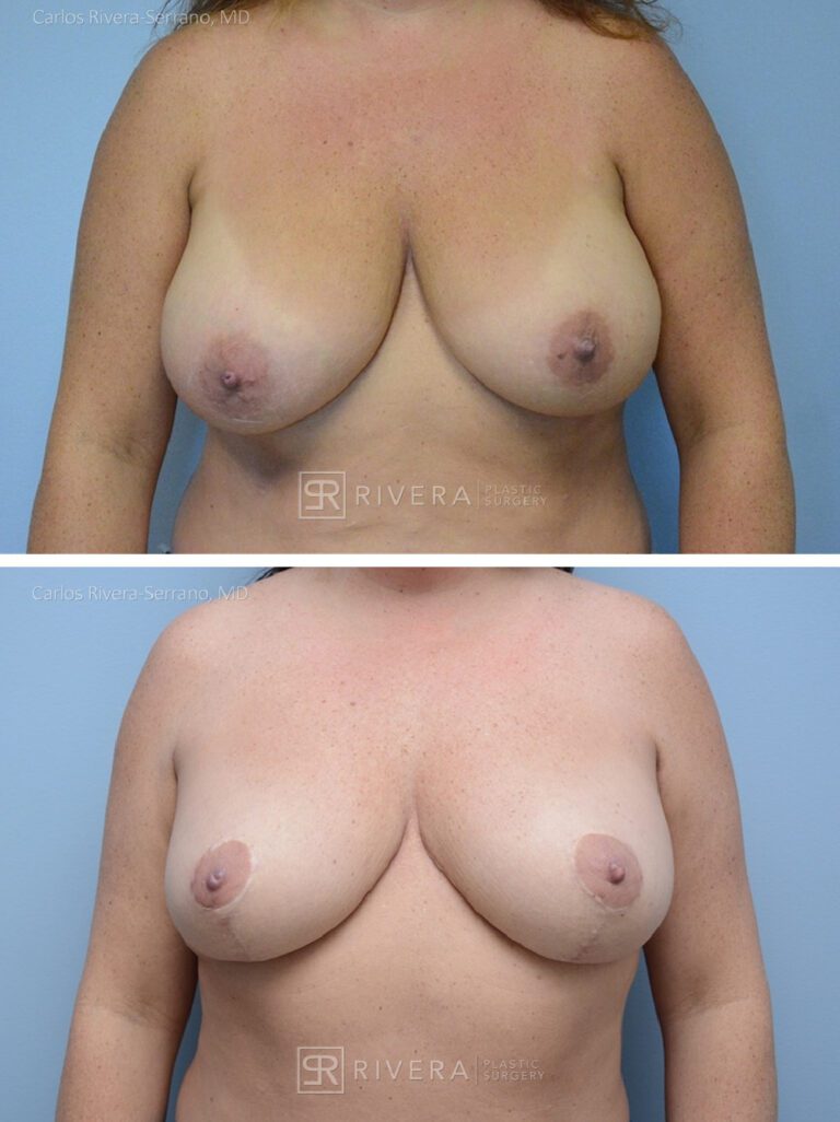 breastreduction case5 dr carlos rivera serrano