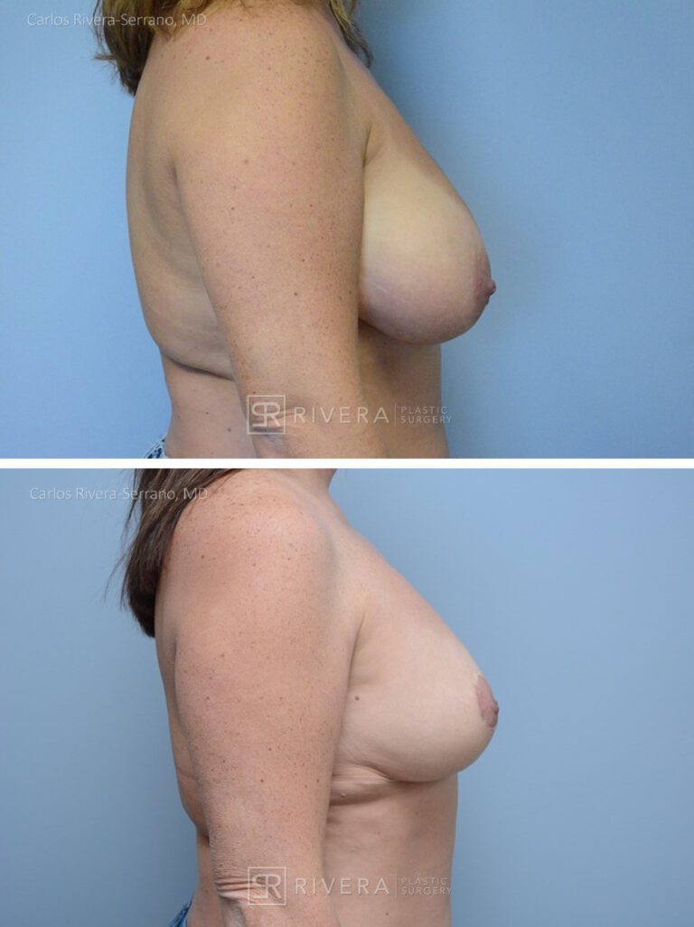 Bilateral breast reduction superomedial dermoglandular pedicle, Wise skin pattern approach (inverted T) - Woman - Case 2305 - Before and after - Lateral view