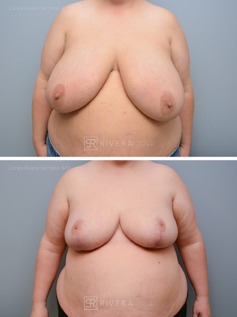 Bilateral breast reduction superomedial dermoglandular pedicle, Wise skin pattern approach (inverted T) - Woman - Case 2306 - Before and after - Frontal view