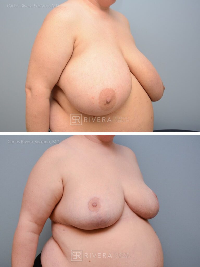 Bilateral breast reduction superomedial dermoglandular pedicle, Wise skin pattern approach (inverted T) - Woman - Case 2306 - Before and after - Oblique view