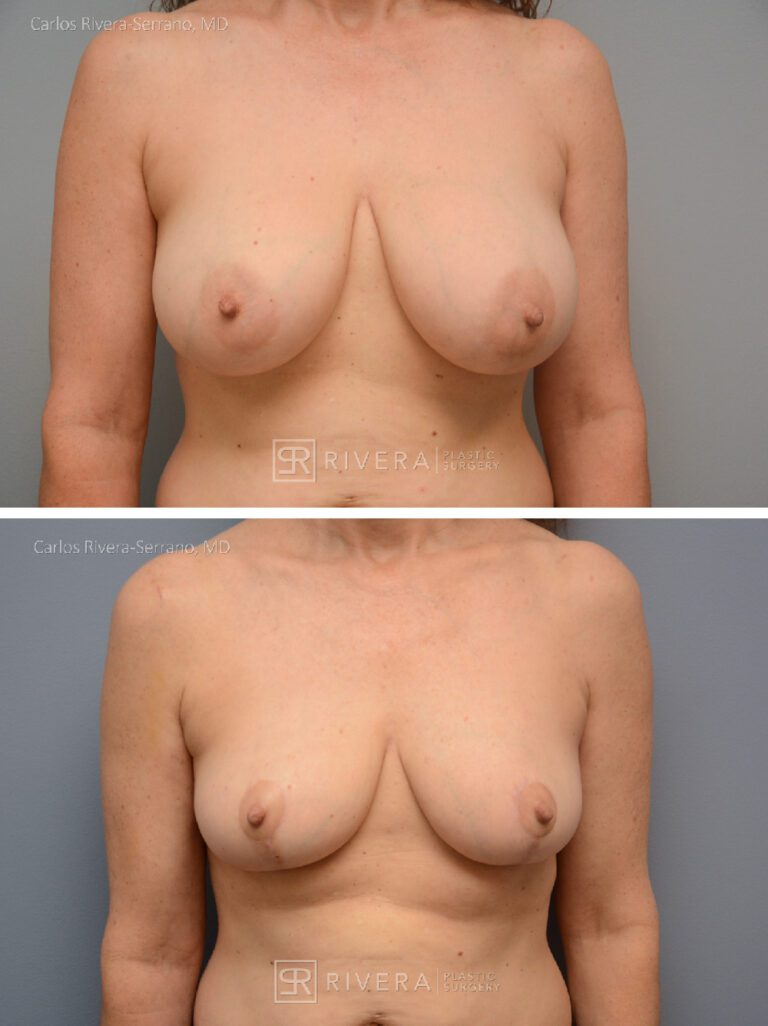 Bilateral breast reduction superomedial dermoglandular pedicle, Wise skin pattern approach (inverted T) - Woman - Case 2307 - Before and after - Frontal view