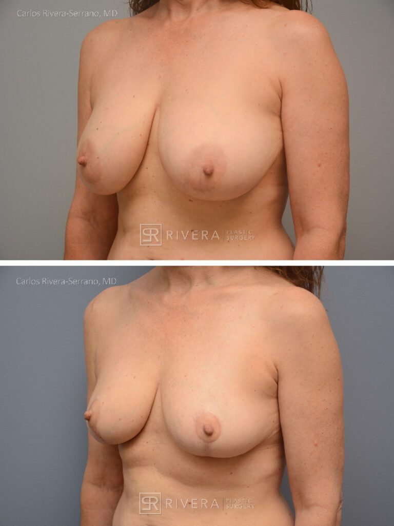 Bilateral breast reduction superomedial dermoglandular pedicle, Wise skin pattern approach (inverted T) - Woman - Case 2307 - Before and after - Oblique view