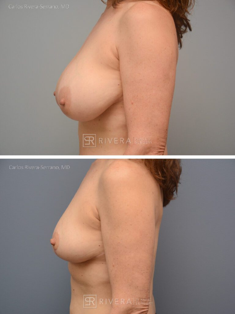 Bilateral breast reduction superomedial dermoglandular pedicle, Wise skin pattern approach (inverted T) - Woman - Case 2307 - Before and after - Lateral view