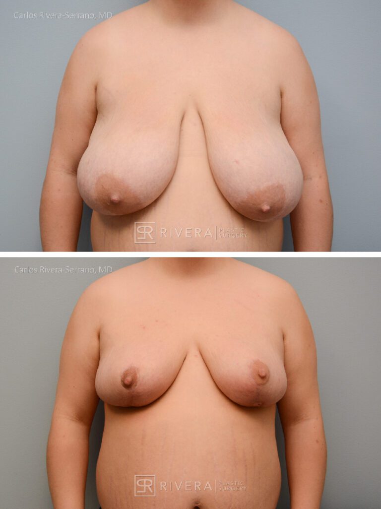 Bilateral breast reduction superomedial dermoglandular pedicle, Wise skin pattern approach (inverted T) - Woman - Case 2308 - Before and after - Frontal view