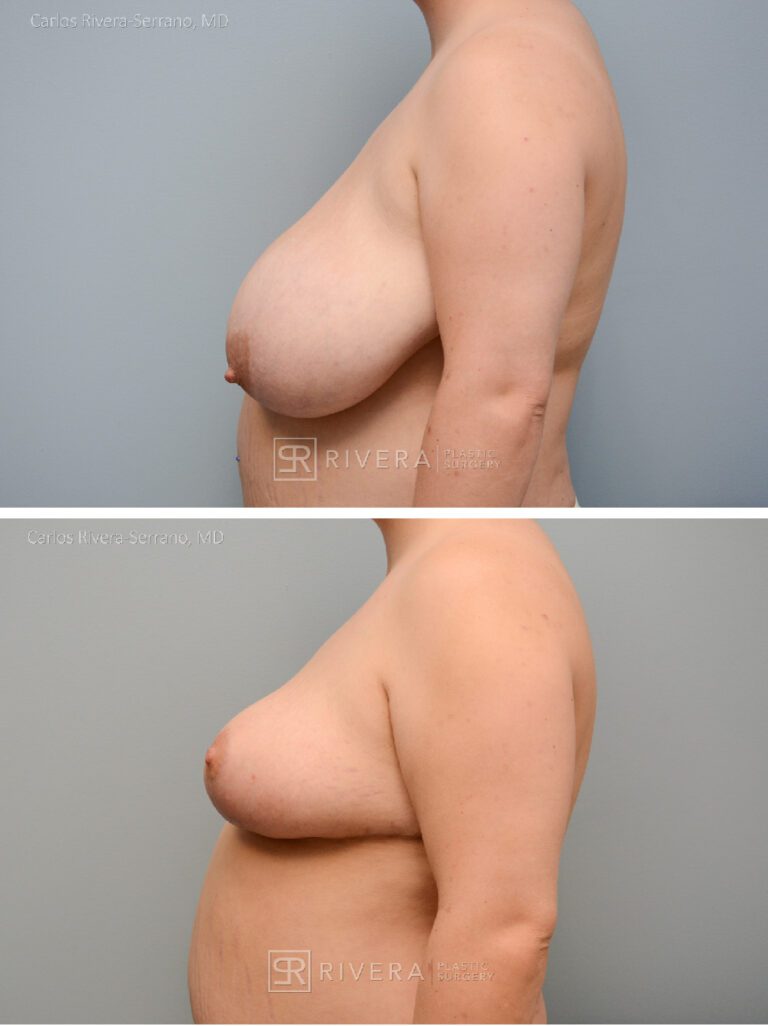 Bilateral breast reduction superomedial dermoglandular pedicle, Wise skin pattern approach (inverted T) - Woman - Case 2308 - Before and after - Lateral view