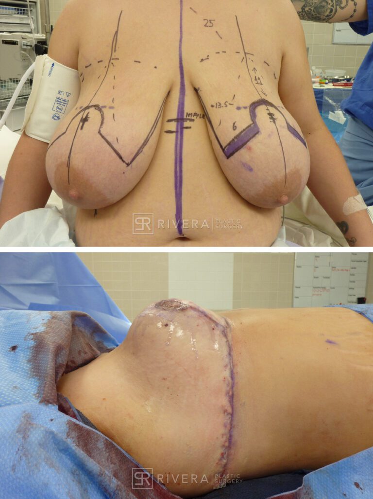 Bilateral breast reduction superomedial dermoglandular pedicle, Wise skin pattern approach (inverted T) - Woman - Case 2308 - Before and after - Frontal and Lateral view