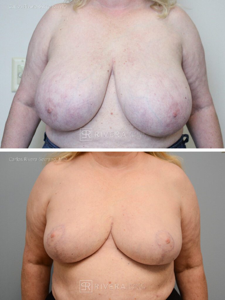 breastreduction case9 dr carlos rivera serrano