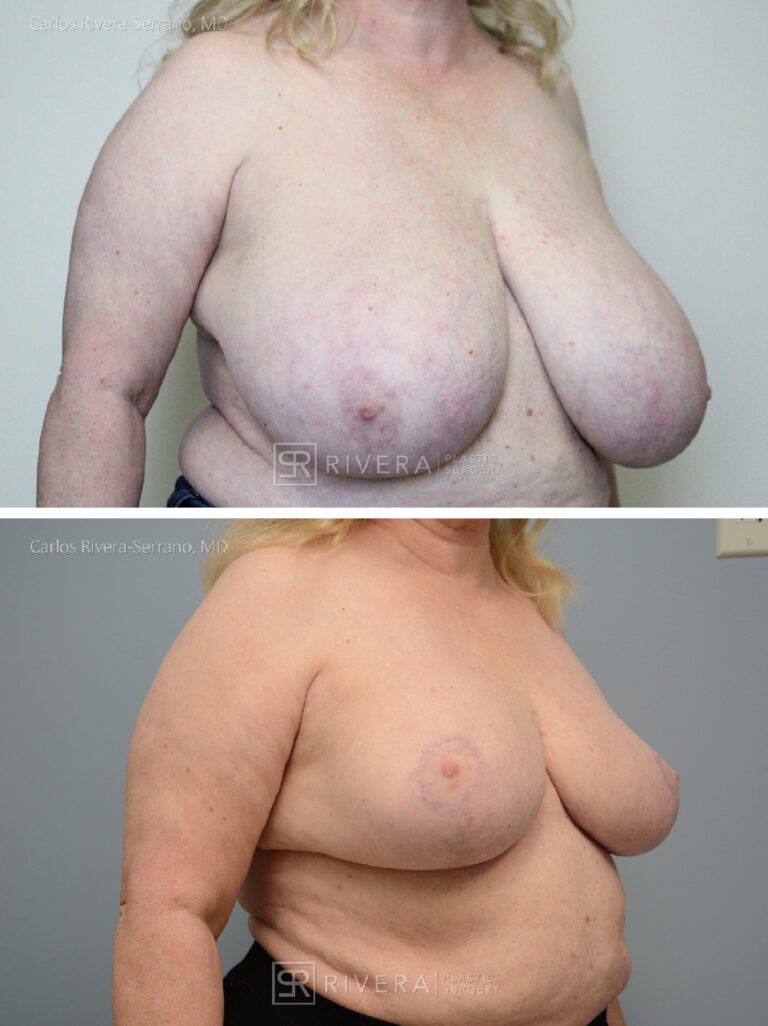 Bilateral breast reduction superomedial dermoglandular pedicle, Wise skin pattern approach (inverted T) - Woman - Case 2309 - Before and after - Oblique view
