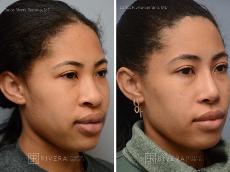 Buccal fat removal surgery woman - Bichectomy - Before and after case 1 - Lateral view