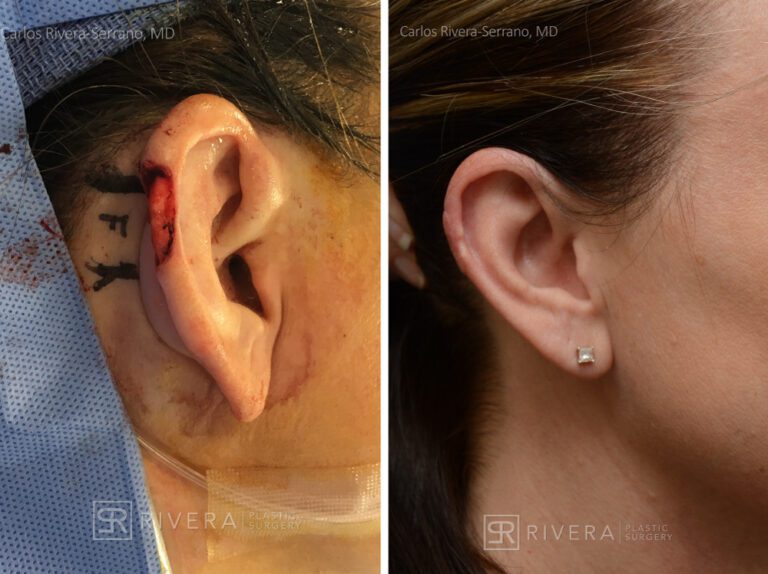 Right ear reconstruction (helix) from skin cancer removal with Post Auricular flap (2 stages) - Woman - Case 17305 - Before and after - Lateral view