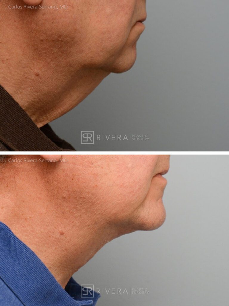 Facelift - Man - Case 11112 - Before and after - Lateral view