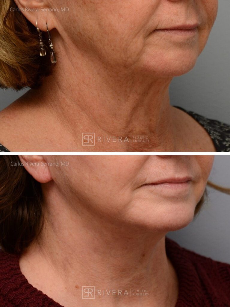 Chin & cheek augmentation surgery woman - Chin implant augmentation - Chin & cheek - Before and after case 4 - Lateral view