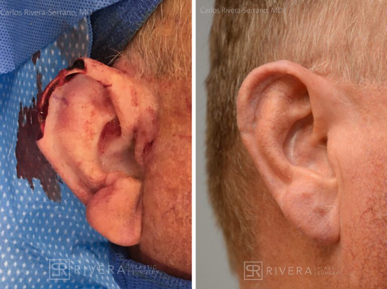 Ear reconstrRight ear (helix) reconstruction from skin cancer removal with Post Auricular flap (2 stages) - Man - Case 17301 - Before and after - Lateral viewuction surgery man - Ear surgery - Skin cancer - Before and after case 1 - Profile View