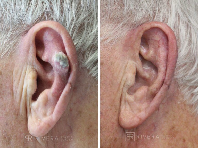 Left ear reconstruction from skin cancer removal (Cutaneous Horn)with Post Auricular flap (2 stages) - Man - Case 17302 - Before and after - Lateral view